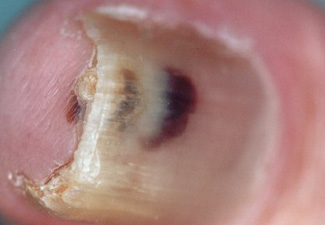 Melanoma of nail unit | DermNet New Zealand