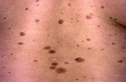Atypical mole syndrome